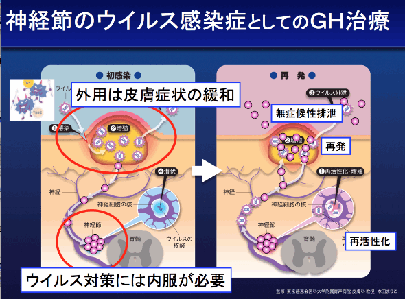 女性 治す 精 早く 器 ヘルペス