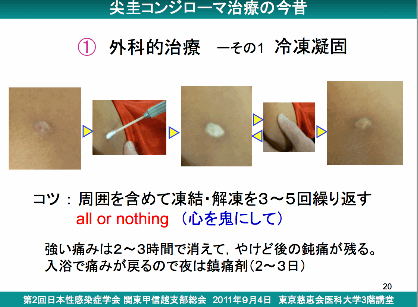 コンジローマ 尖 圭 尖圭コンジローマの解説 症状や感染経路・検査や治療について│STD研究所