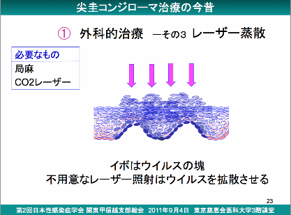 コンジローマ 放置