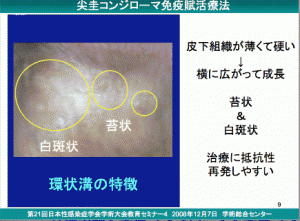 尖圭コンジローマ　新宿さくらクリニック