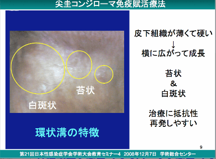 尖 圭 コンジローマ 画像