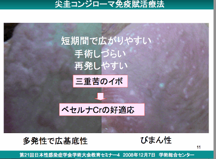 尖圭コンジローマ診断の実際 Dr Sawamura S性病事典 新宿さくらクリニック