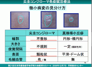 尖圭コンジローマ　新宿さくらクリニック