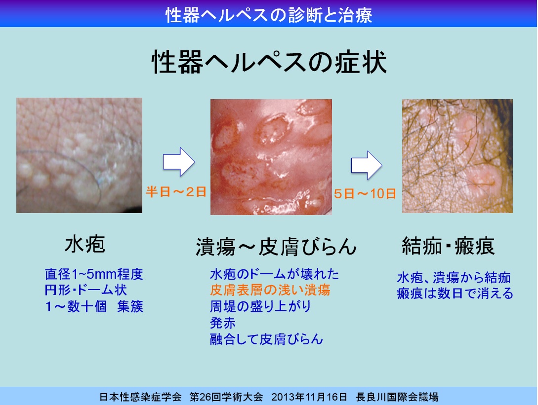 性器ヘルペスの実践的な診断手順 Dr Sawamura S性病事典 新宿さくらクリニック